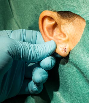 Split earlobe – Miracle Skin Hair and Aesthetic Clinic