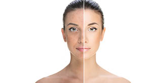 Skin Rejuvenation