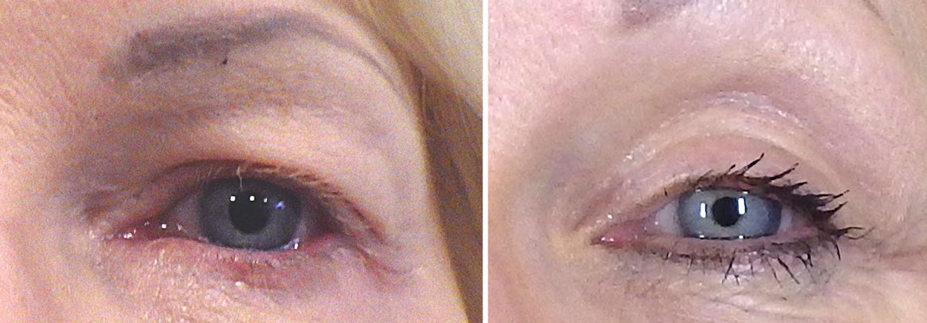 Eyelid Rejuvenation