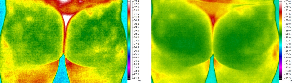 BTL Unison Thermal Image